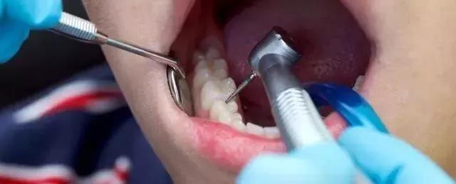 牙齿修复黑科技：浙大发明神奇牙齿修补液 滴两滴就能修补牙釉质